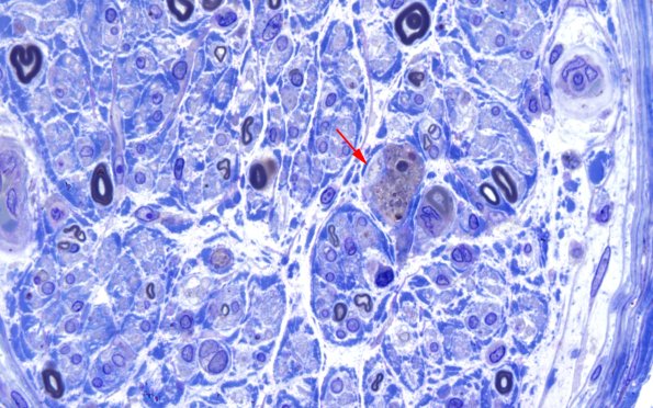 2E4 GBS (Case 2) Plastic 100X 3 copy