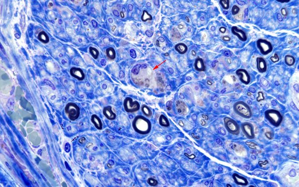 2E5 GBS (Case 2) Plastic 100X 5 copy