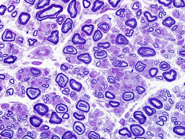 3A1 GBS (Case 3) Nerve Bx Plastic 1 copy.jpg