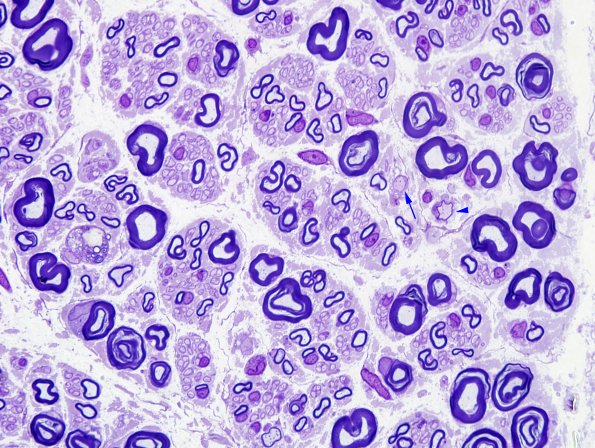 3A2 GBS (Case 3) Nerve Bx Plastic 3 copy.jpg