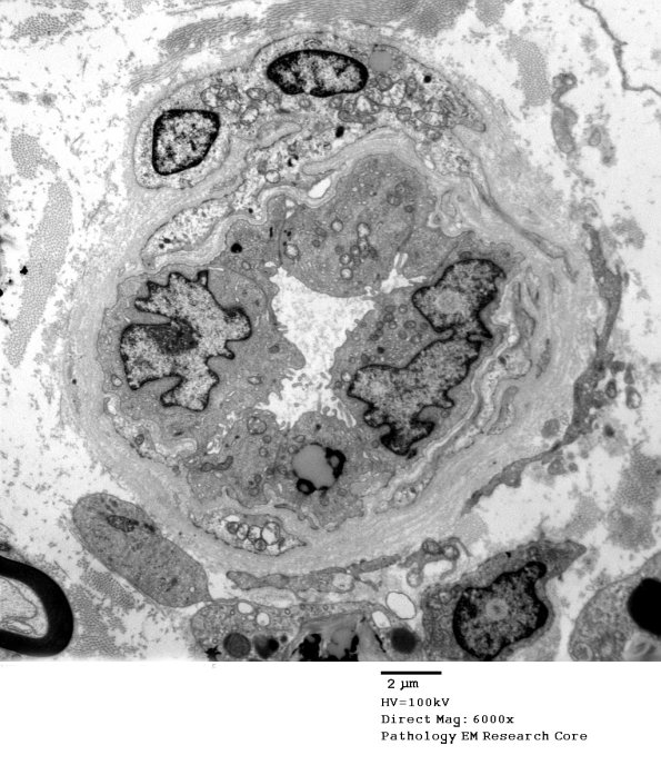 3B10 NB84-12 GBS Nerve Bx_009 - Copy