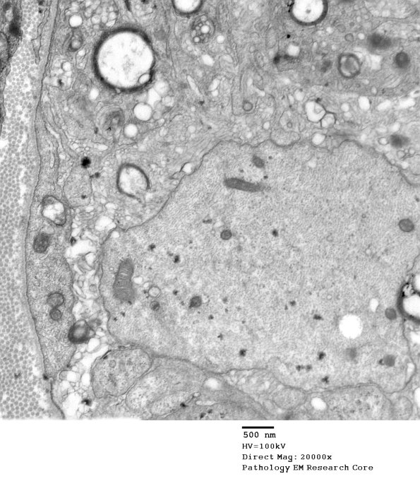 3B1B Case 3 GBS Nerve Bx_025 - Copy