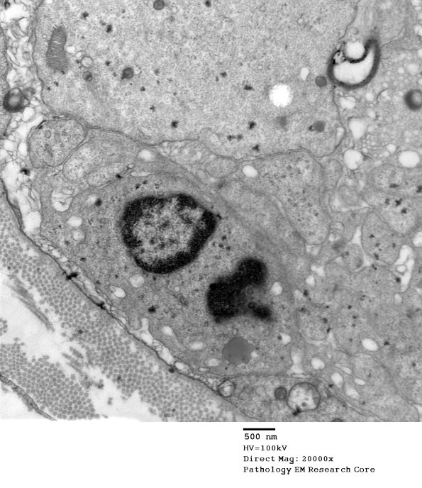 3B1C Case 3 GBS Nerve Bx_026 - Copy