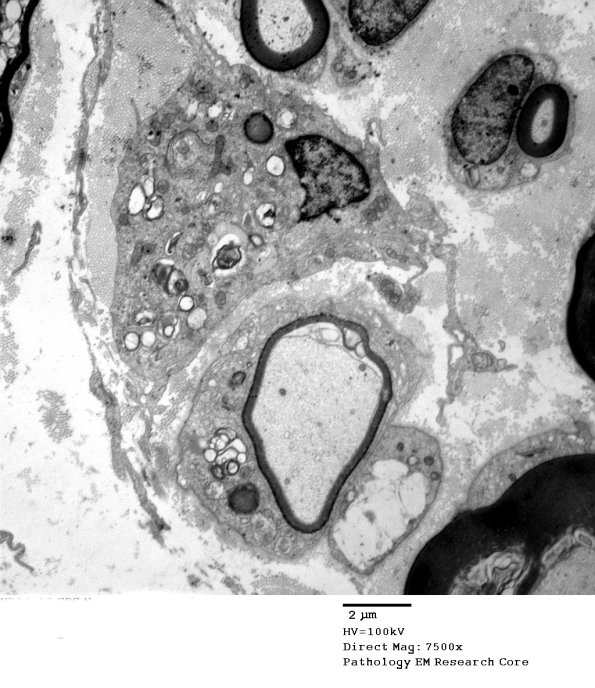 3B3A Case 3 GBS Nerve Bx_013 - Copy