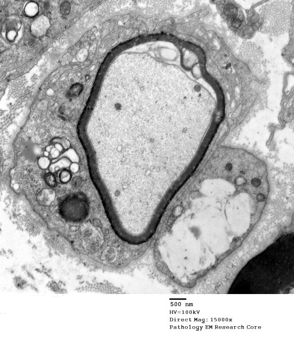3B3B Case 3 GBS Nerve Bx_010 - Copy