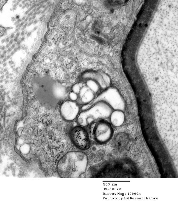 3B3C Case 3 GBS Nerve Bx_012 - Copy