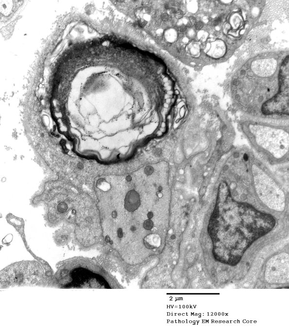 3B4B Case 3 GBS Nerve Bx_030 - Copy