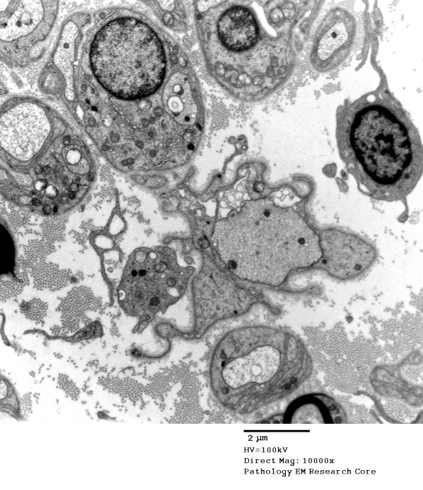 3B6 Case 3 GBS Nerve Bx_031 - Copy