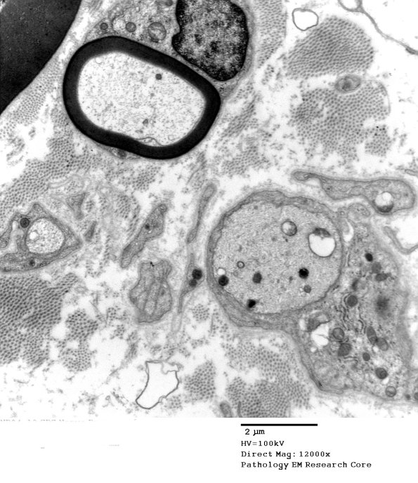 3B7 Case 3 GBS Nerve Bx_015 - Copy