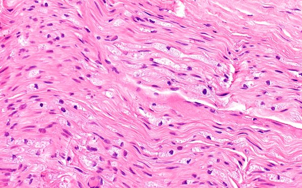 4A2 GBS, fulminant (Case 4) H&E 40X 1