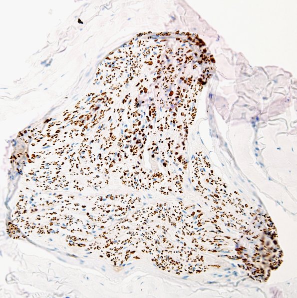 4B1 GBS,, fulminant (Case 4) NF 1