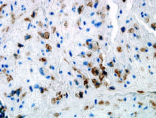 4C GBS, fulminant (Case 4) CD163 7