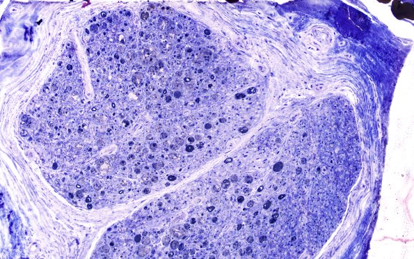 4D1, fulminant (Case 4) Plastic  20X