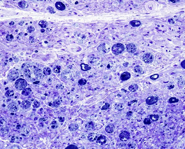 4D2 GBS, fulminant (Case 4) Plastic 4