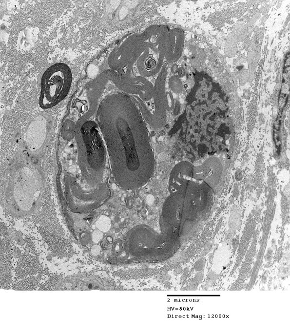 4D3 GBS, fulminant (Case 4)  029 - Copy