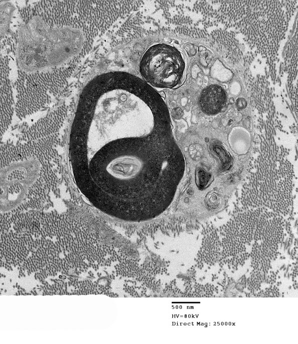4D4 GBS, fulminant (Case 4) 058 - Copy