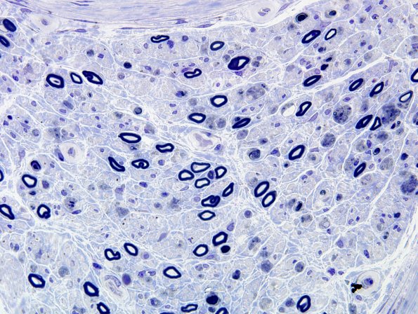 4E2 GBS, fulminant (Case 4) Plastic 1C.jpg