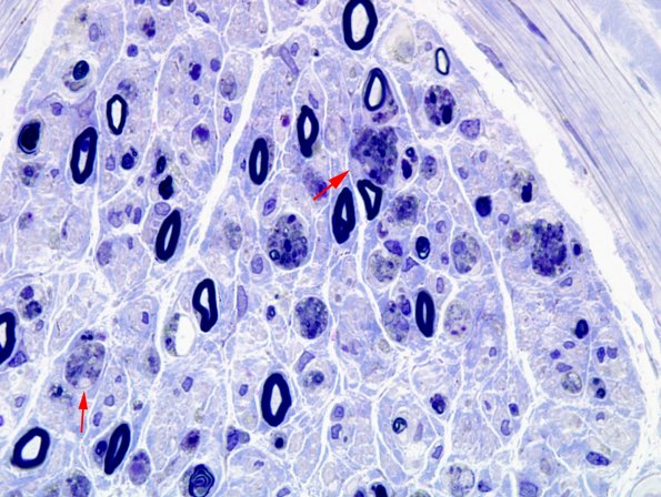4E3 GBS, fulminant (Case 4) Plastic 14 copy copy
