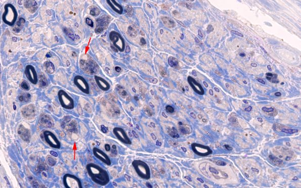 4E4 , fulminant (Case 4) Plastic 100X 1 copy