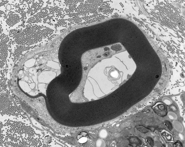 4F1  GBS, fulminant (Case 4) 136a - Copy