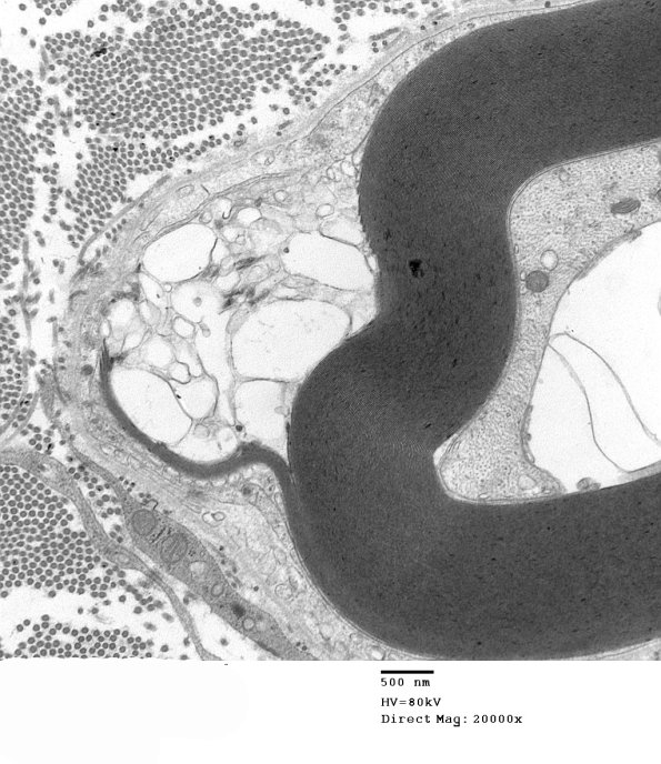 4F2 GBS, fulminant (Case 4) 137a - Copy