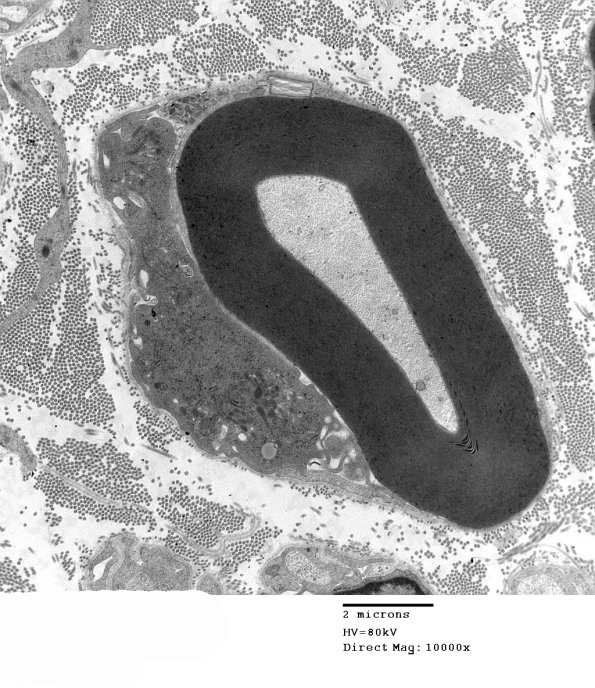4F3 GBS, fulminant (Case 4) 129a - Copy