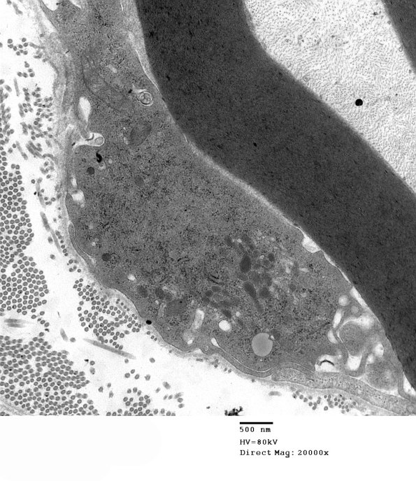 4F4 GBS, fulminant (Case 4) 132a - Copy