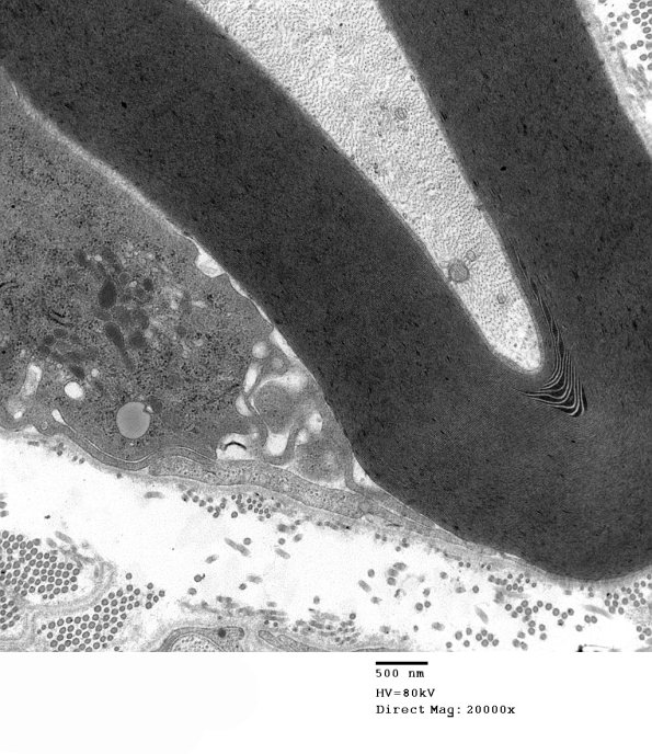 4F6 GBS, fulminant (Case 4) 130a - Copy