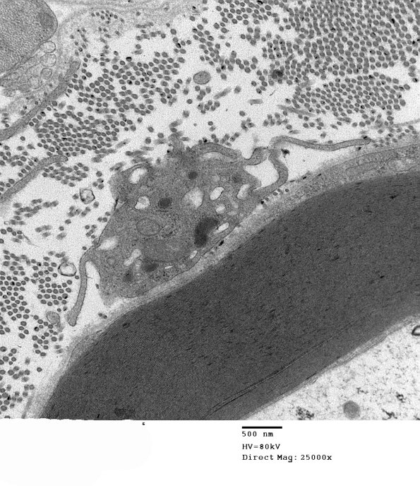 4F7 GBS, fulminant (Case 4) 108a - Copy