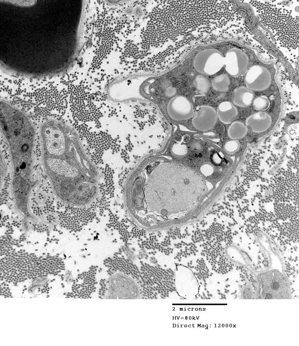4F8 GBS, fulminant (Case 4) 140a - Copy