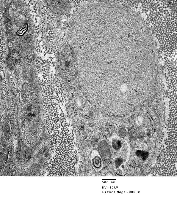 4F9 GBS, fulminant (Case 4) 090 - Copy