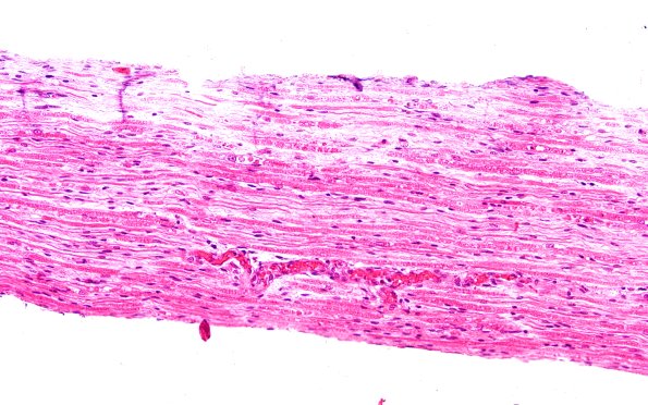 5A1 (Case 5) H&E 20X 1