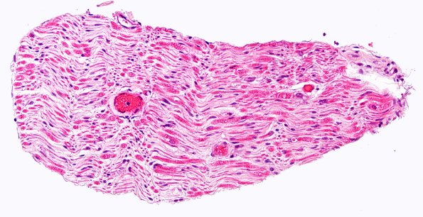 5A2 (Case 5) H&E 20X 2