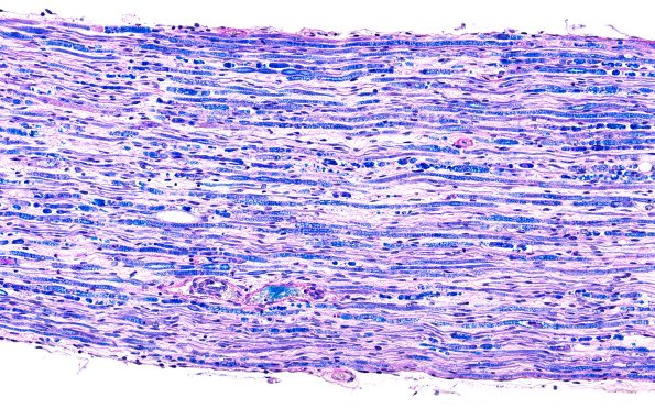 5B (Case 5) LFB-PAS 20X