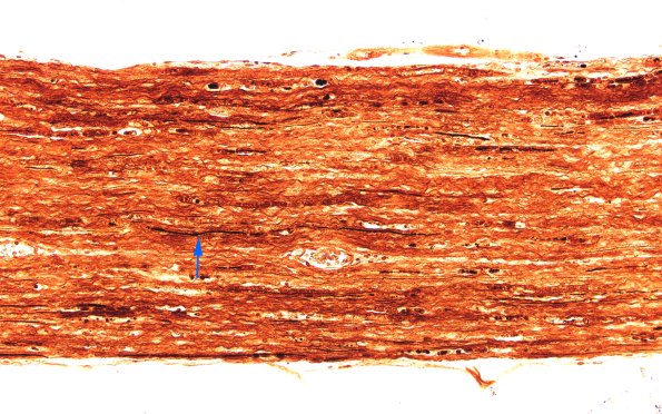 5C1 (Case 5) Sevier-Munger 20X 1 copy