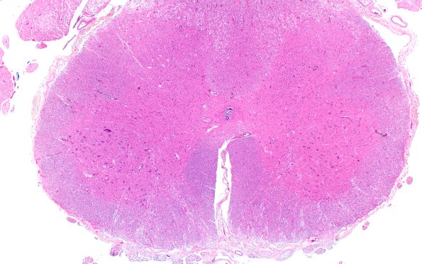 5D1 (Case 5) H&E 2X 3