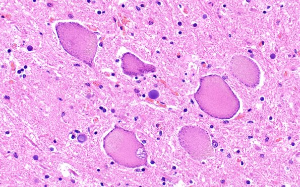 5D2 (Case 5) H&E 40X 3