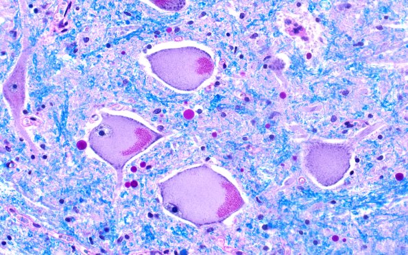 5E (Case 5) LFB-PAS 40X 2