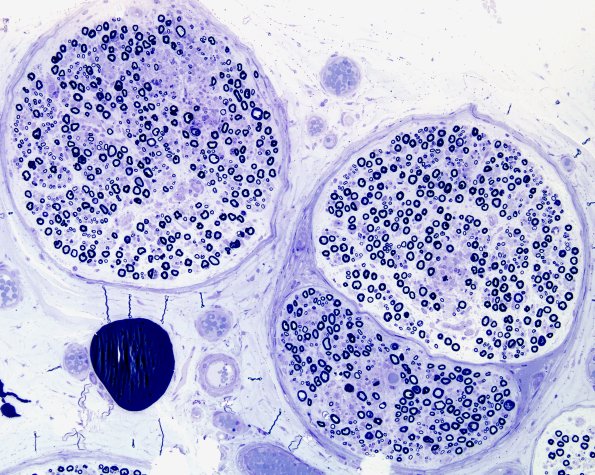 6A1 GBS (Case 6) Plastic 35