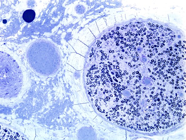 6A2 GBS (Case 6) Plastic 11