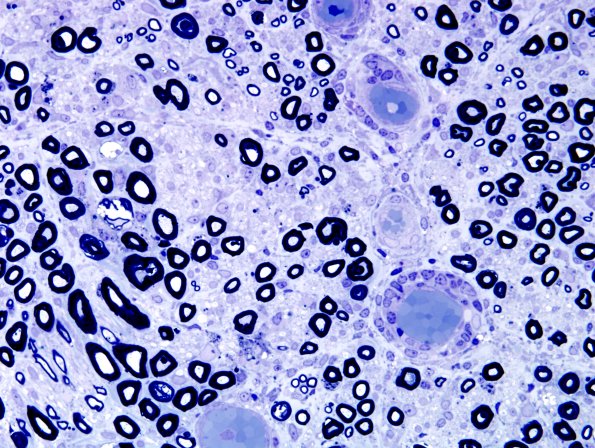 6A3 GBS (Case 6) Plastic 22