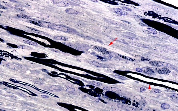 6A6 GBS (Case 6) Plastic 100X 1a copy