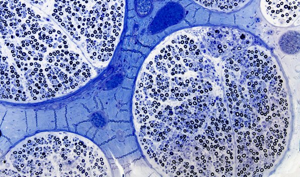 7A1 GBS (Case 7) Plastic 20x 2