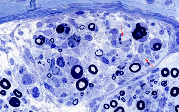 7A2 GBS (Case 7) Plastic 100X 6 copy