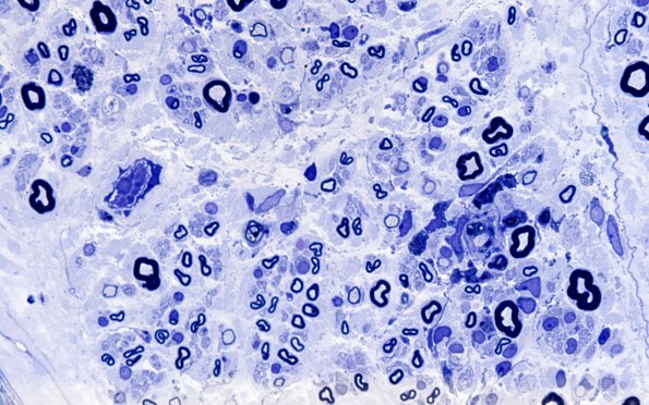 7A3 GBS (Case 7) Plastic 100X 2