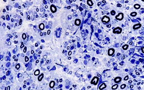 7A4 GBS (Case 7) Plastic 100X 3