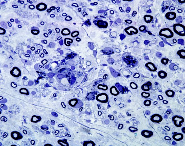 7A5 GBS (Case 7) Plastic 2 best