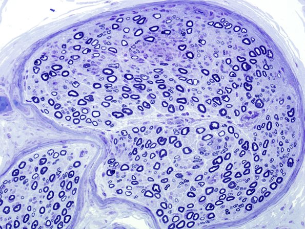 8A1 GBS (Case 8) Plastic 4