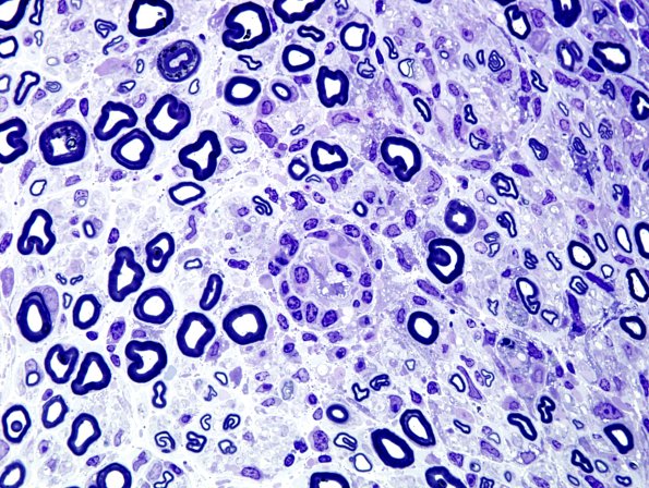 8A2 GBS (Case 8) Plastic 1