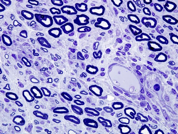 8A3 GBS (Case 8) Plastic 7